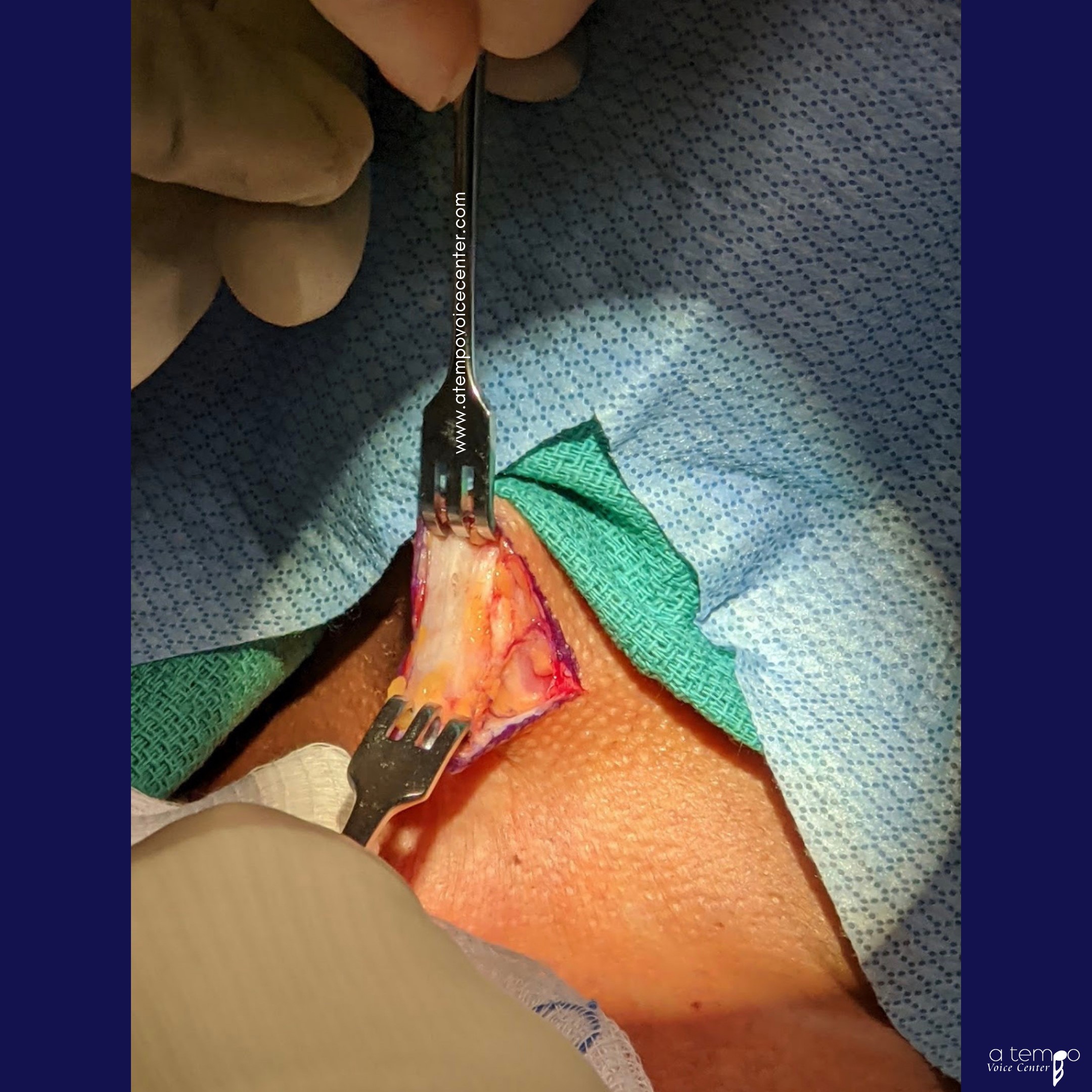 Next, an anterior incision was made across the neck and the tissue was pulled apart.